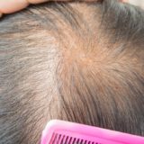 Popular Hair loss treatment in Pakistan