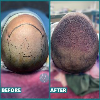 Hair transplant in pakistan