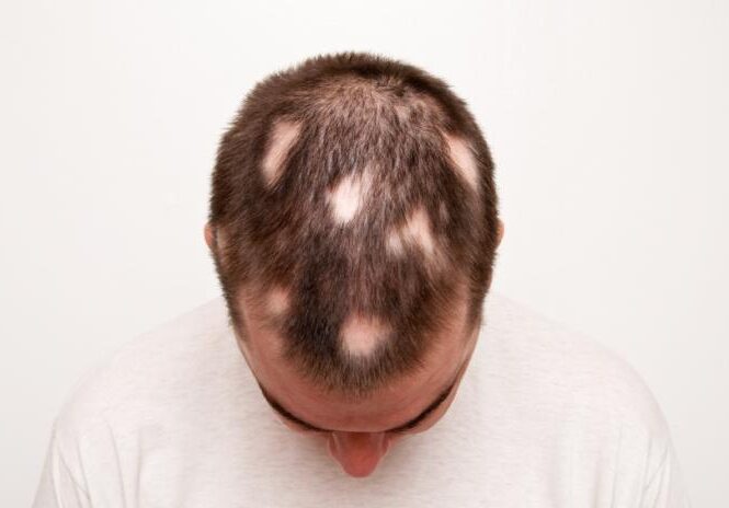 hiar-loss Hair Loss treatment in Lahore Pakistan