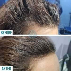 Hair transplant in Lahore Pakistan