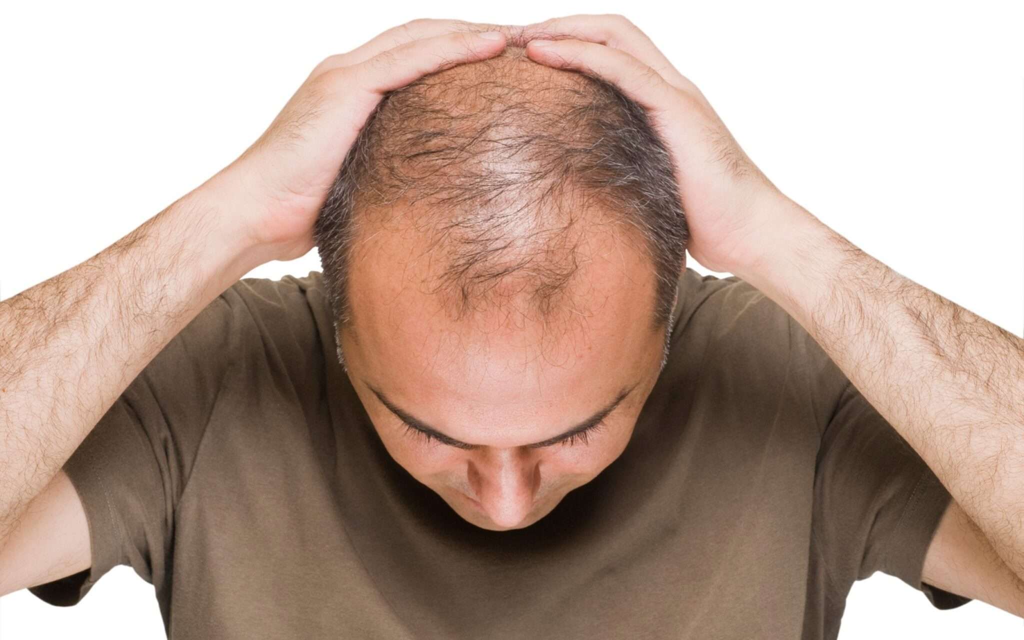 Stress For Hair Loss Hair Loss treatment in Lahore Pakistan