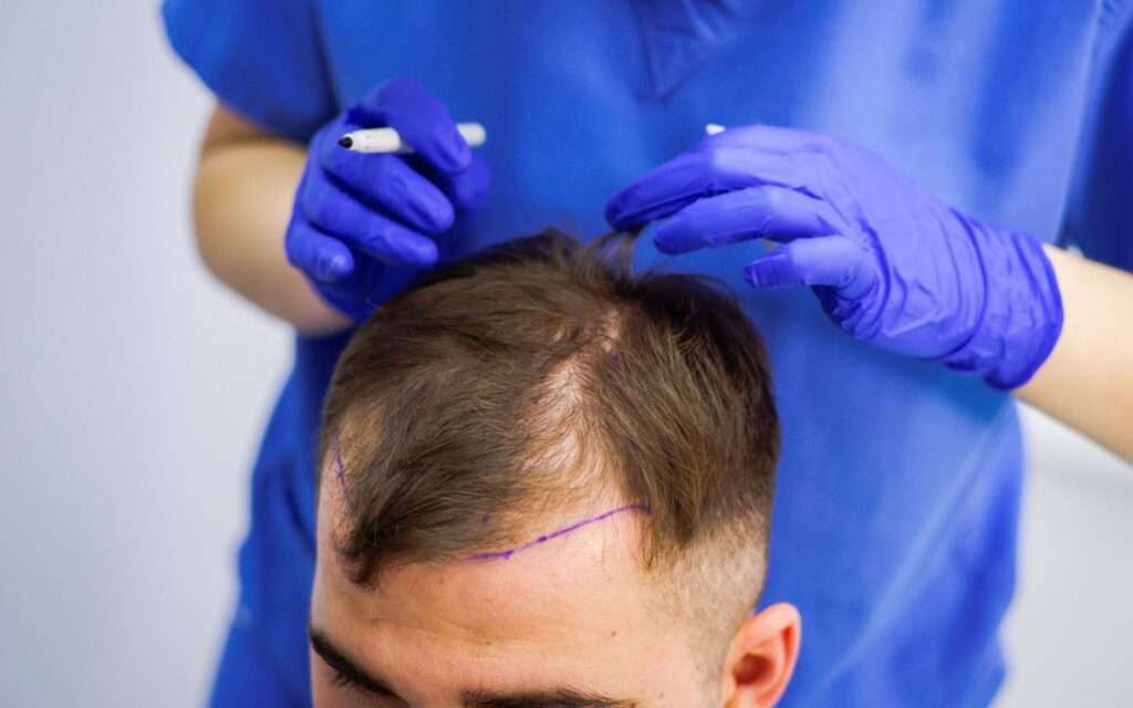 Hair Loss Solution: Why Hair Transplant Is the Best Option Today