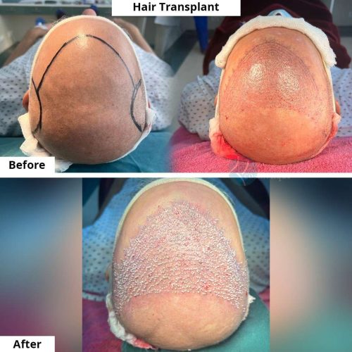 How Hair Transplant Can Change Your Look Instantly