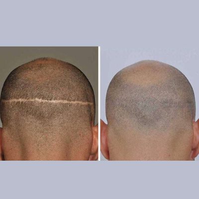 Stop Hair Fall Now with Best Hair Transplant in Lahore at Institute Cosmetique