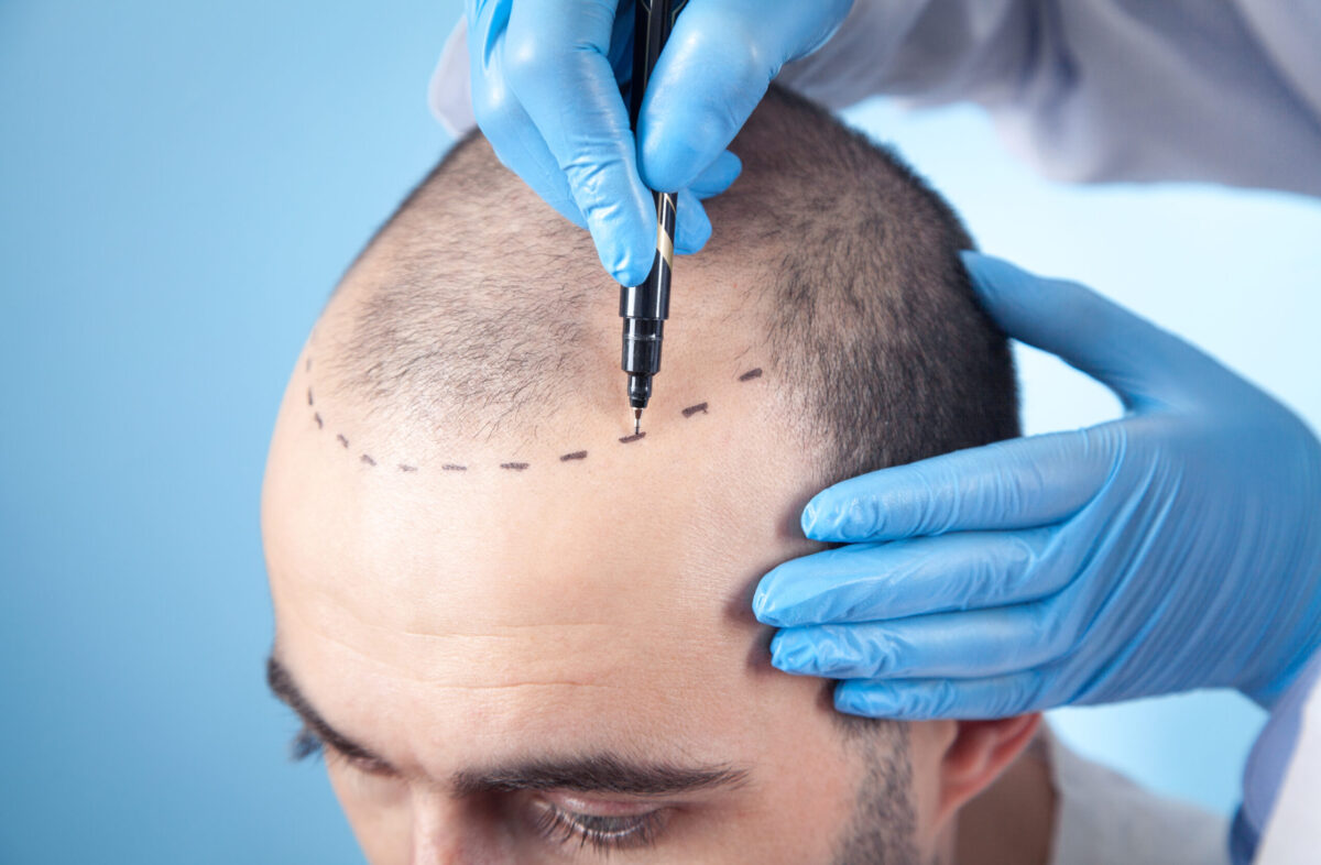Hair transplant surgery showing follicle implantation in scalp