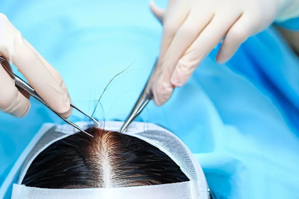 Hair transplant procedure performed by surgeon restoring natural hairline