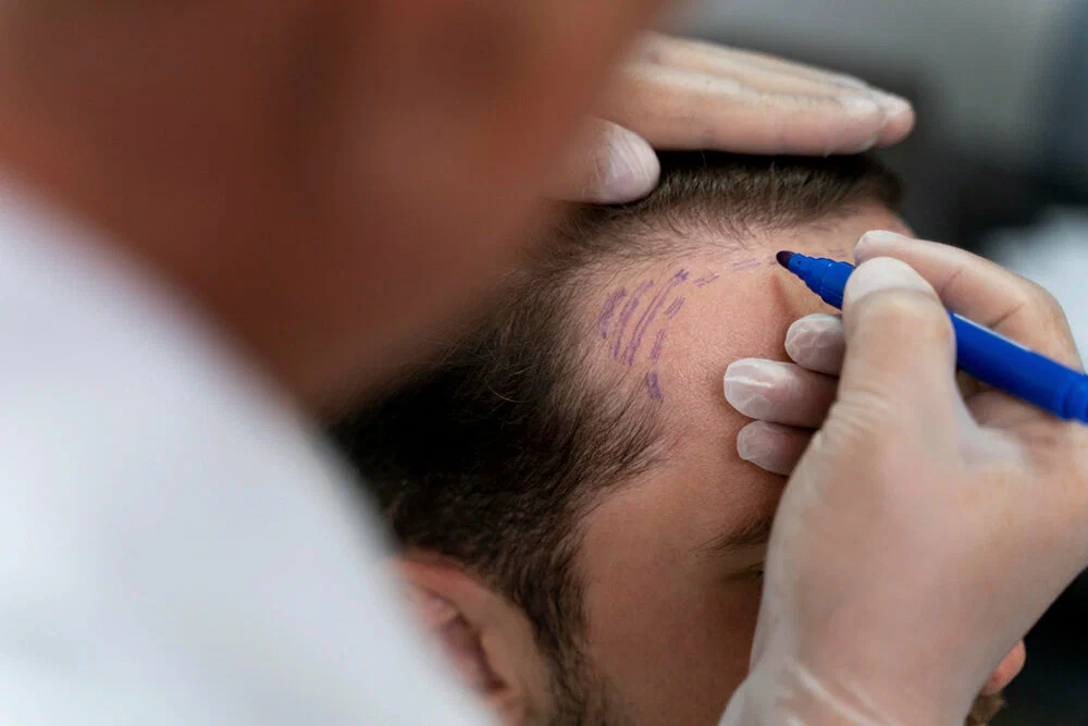 Hair transplant procedure restoring natural hair growth