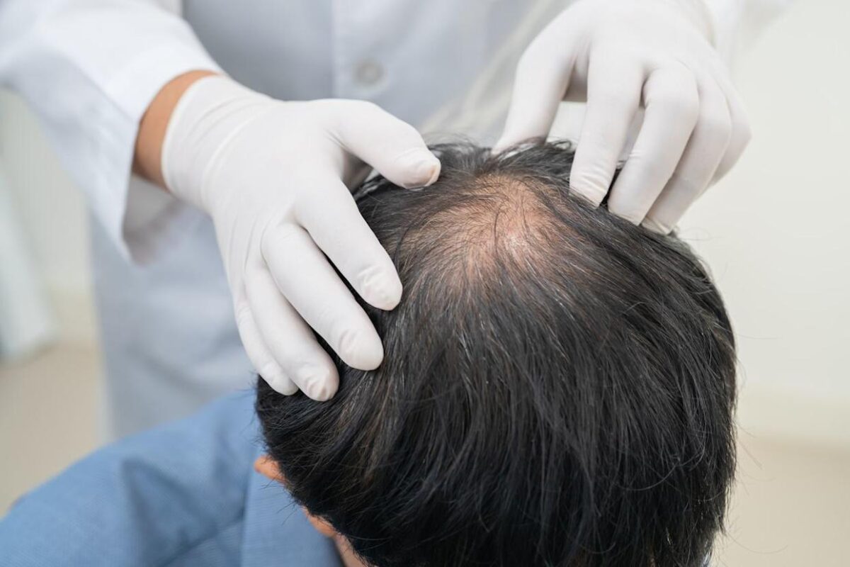 Natural looking hair growth after successful hair transplant procedure
