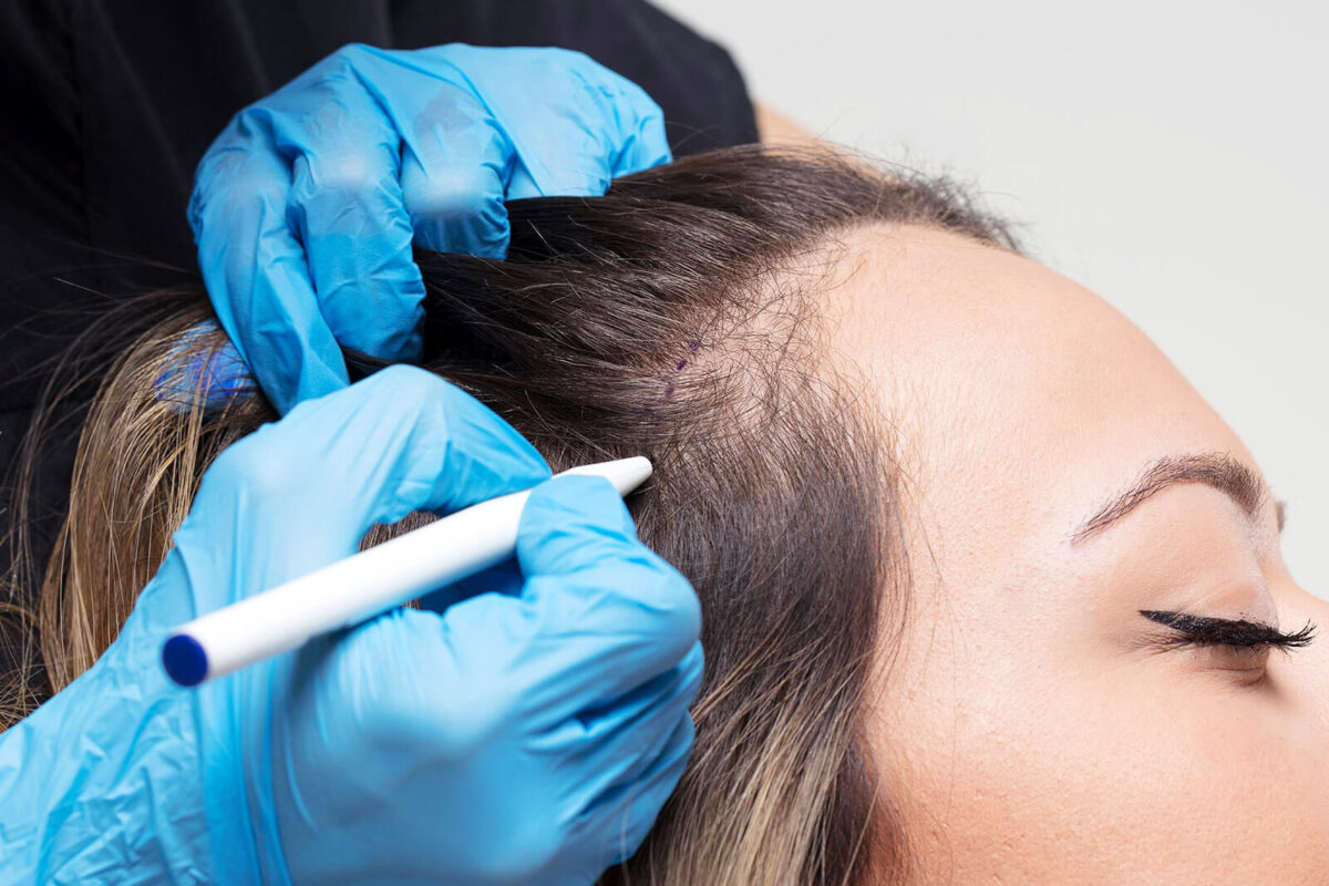 Hair transplant specialist examining scalp before treatment