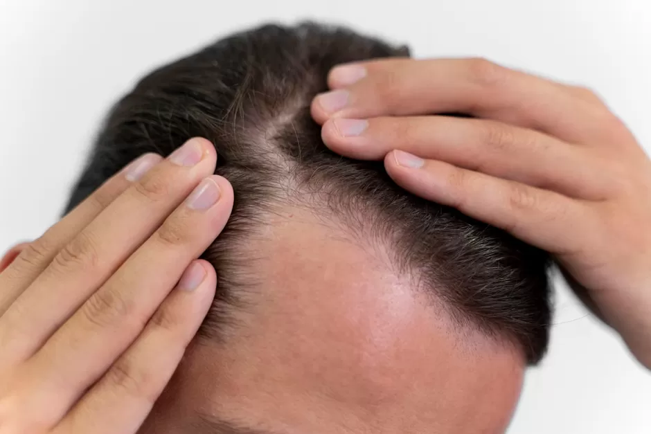 Hair transplant procedure in Lahore by expert surgeons