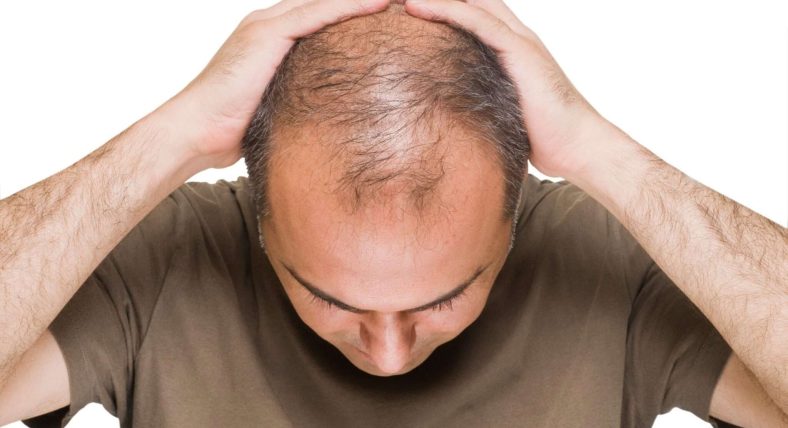 hair transplant